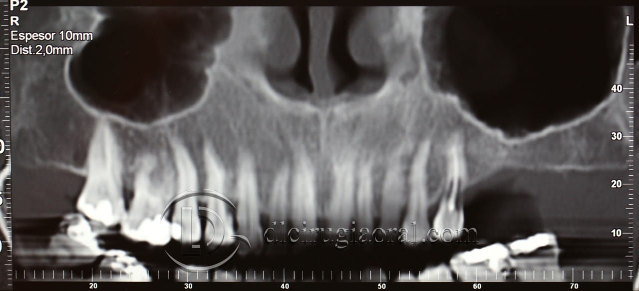Schneiderian membrane perforation