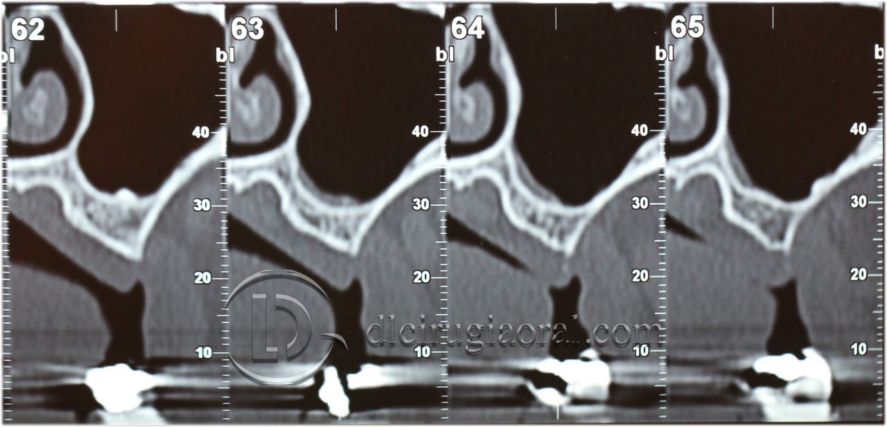 Schneiderian membrane perforation