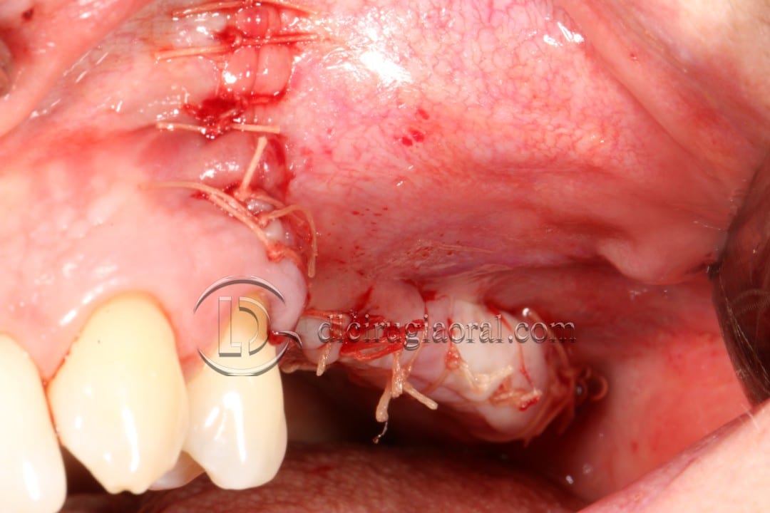 Schneiderian membrane perforation