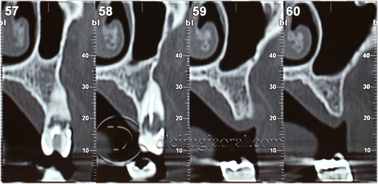 Schneiderian membrane perforation