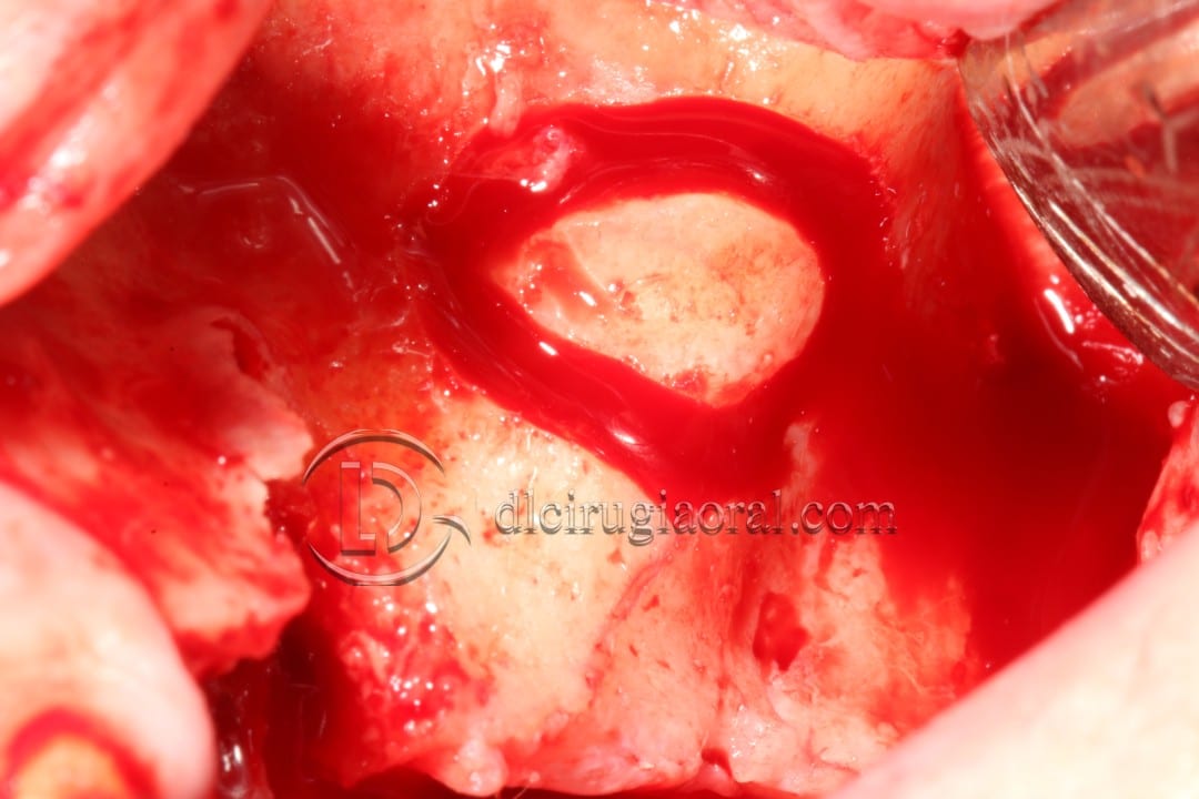 Schneiderian membrane perforation