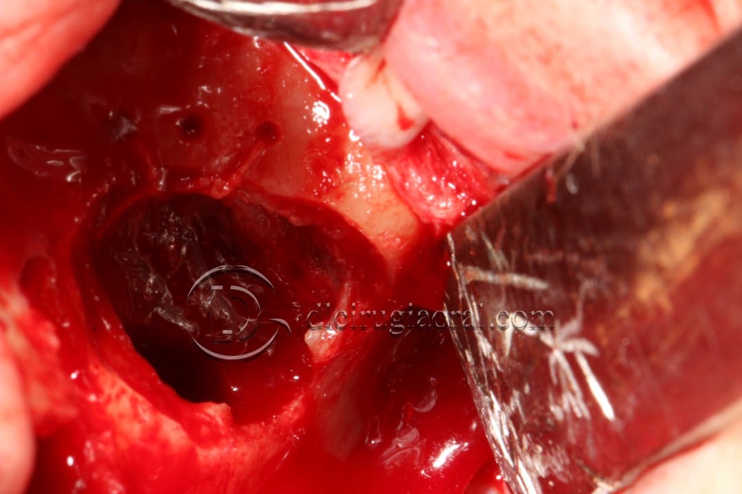 Schneiderian membrane perforation