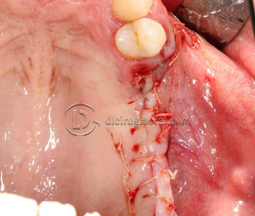 Schneiderian membrane perforation
