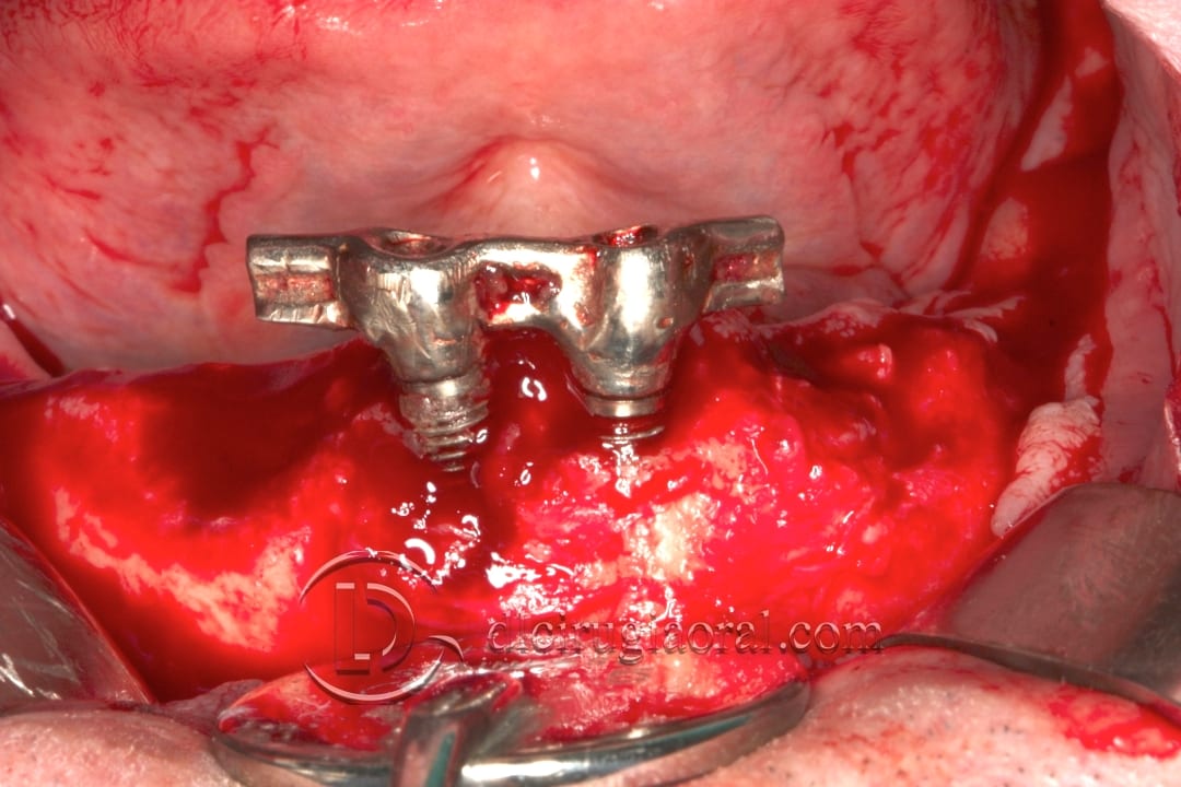 lower overdenture explantation and implantation