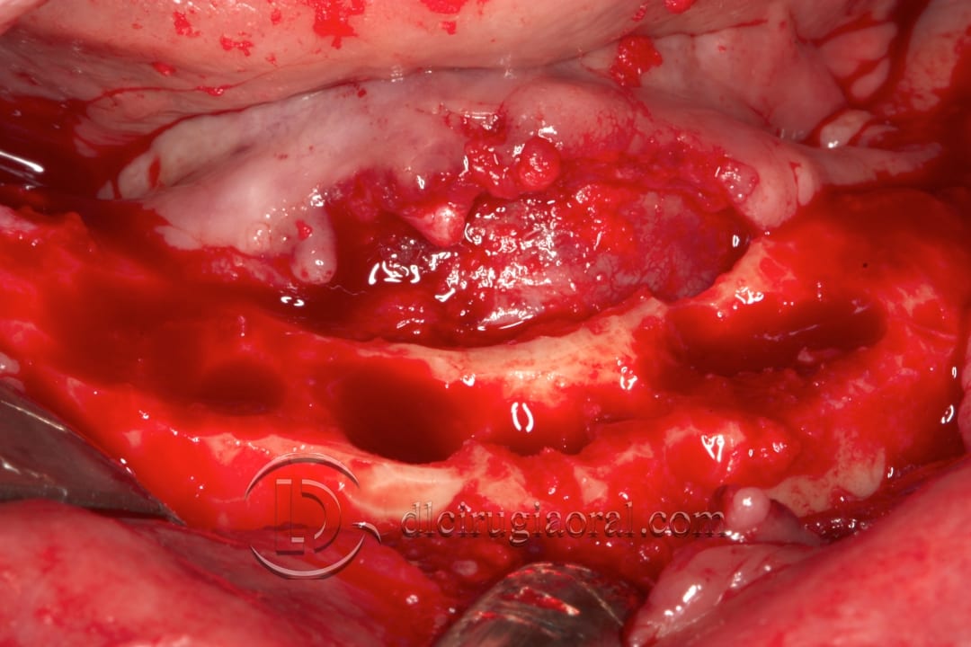 lower overdenture explantation and implantation
