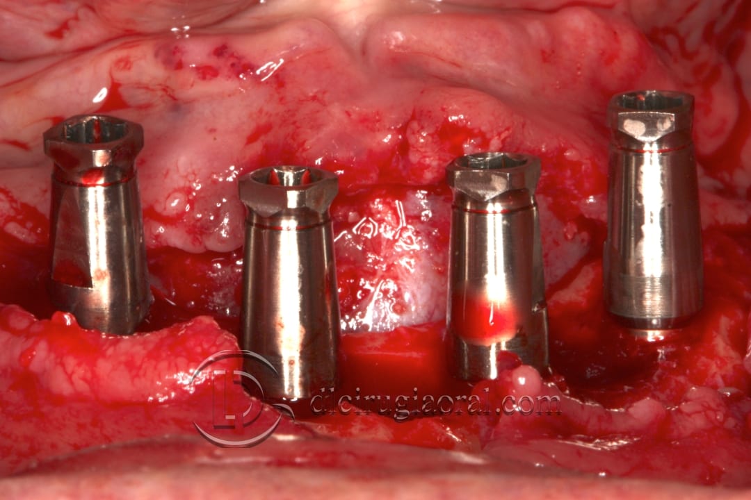 lower overdenture explantation and implantation