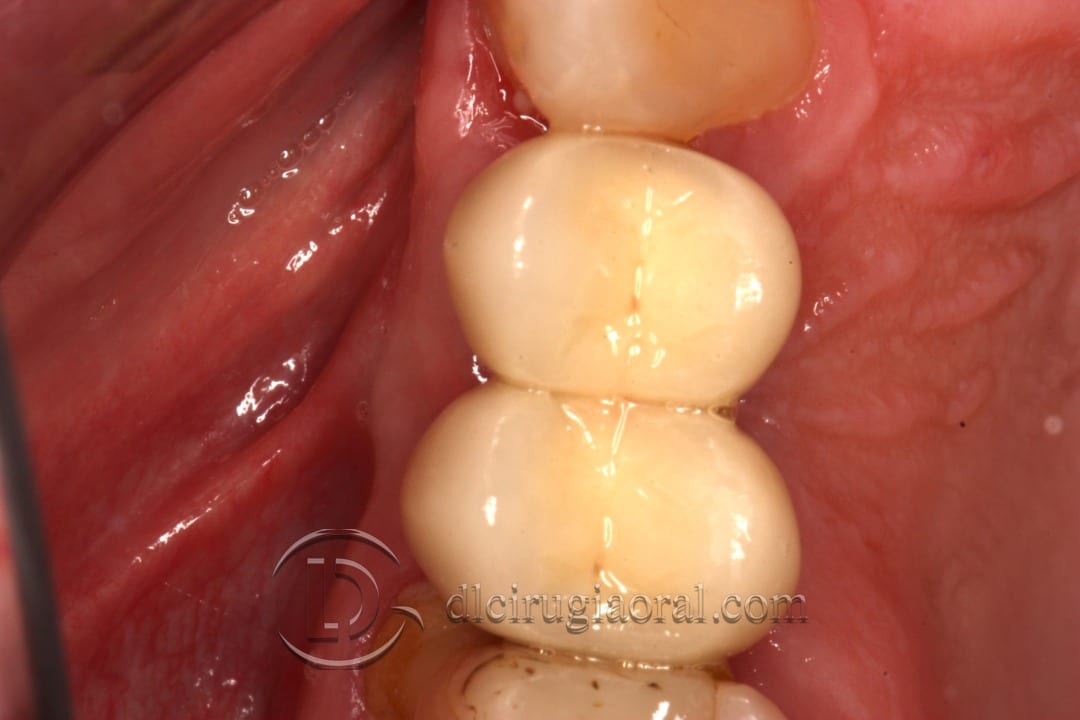 horizontal defect in upper molar