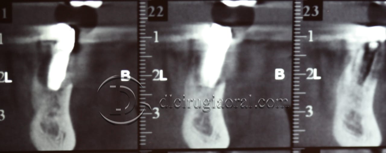 lower overdenture explantation and implantation