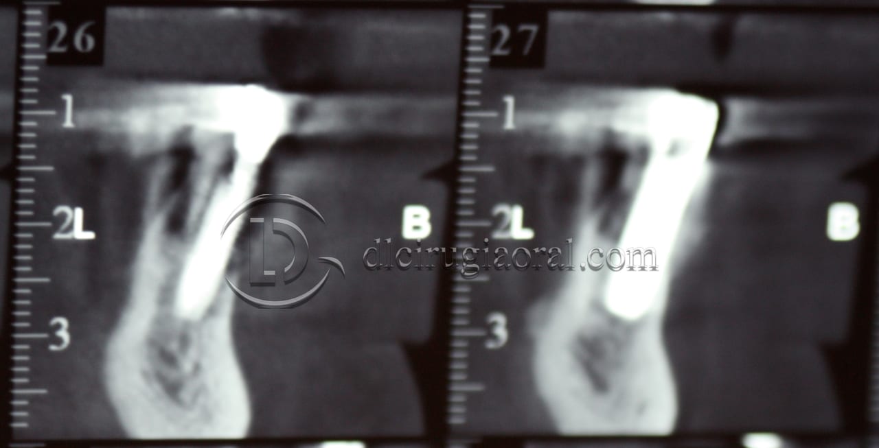 lower overdenture explantation and implantation