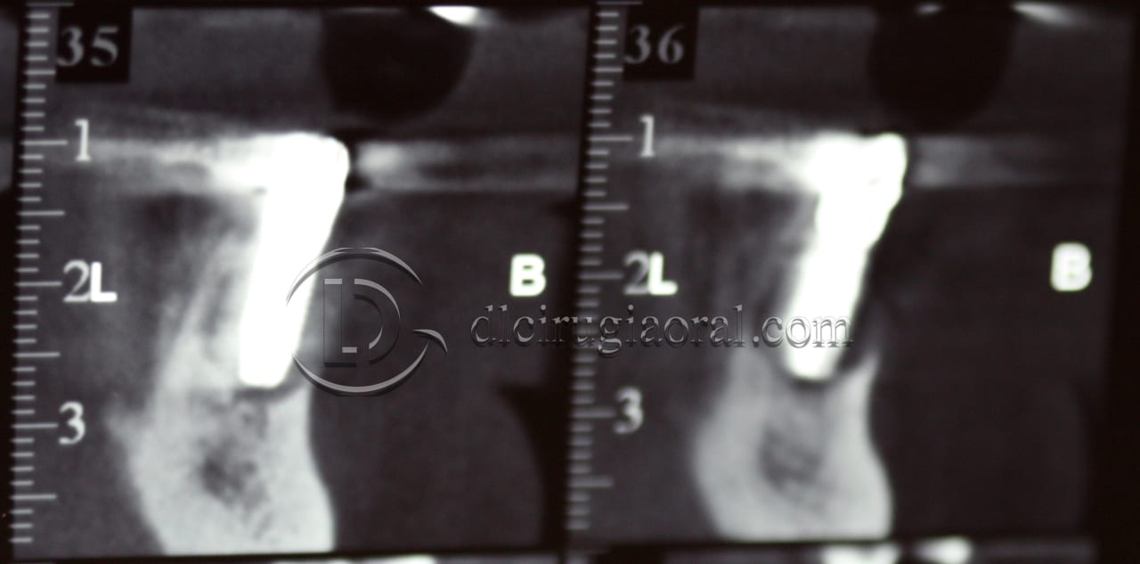 lower overdenture explantation and implantation