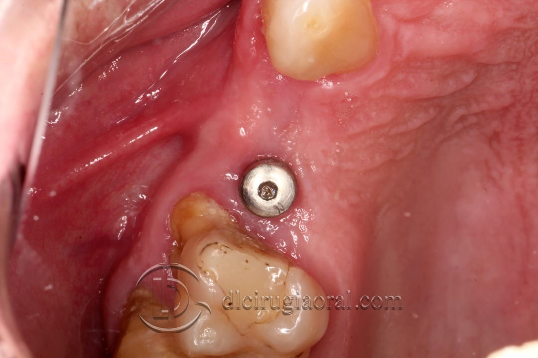 horizontal defect in upper molar
