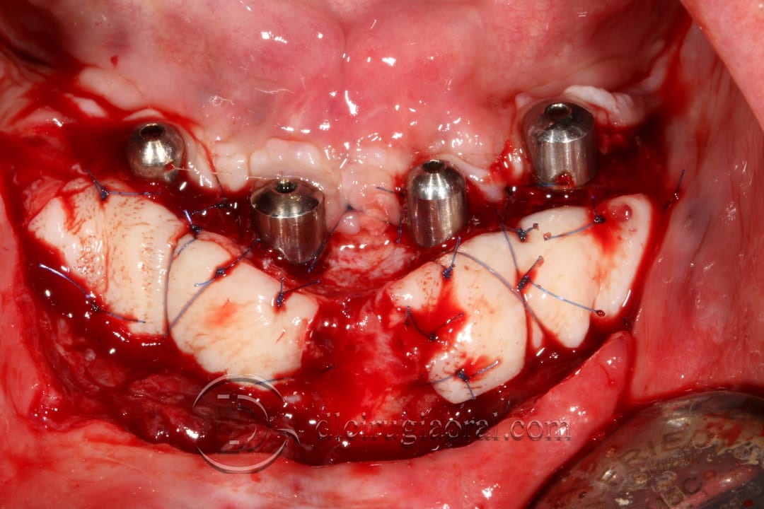 Lower Overdenture Soft Tissue Improvement: Surgical Phase