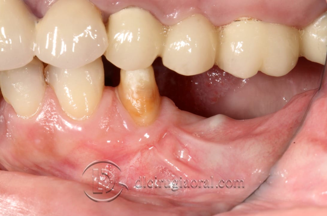 Implants on 3D Mandibular Reconstruction: Clinical Case