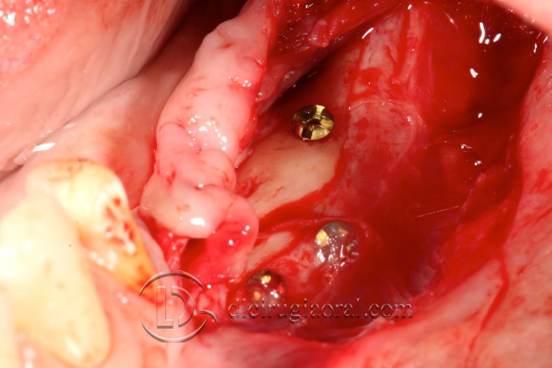Appearance of graft