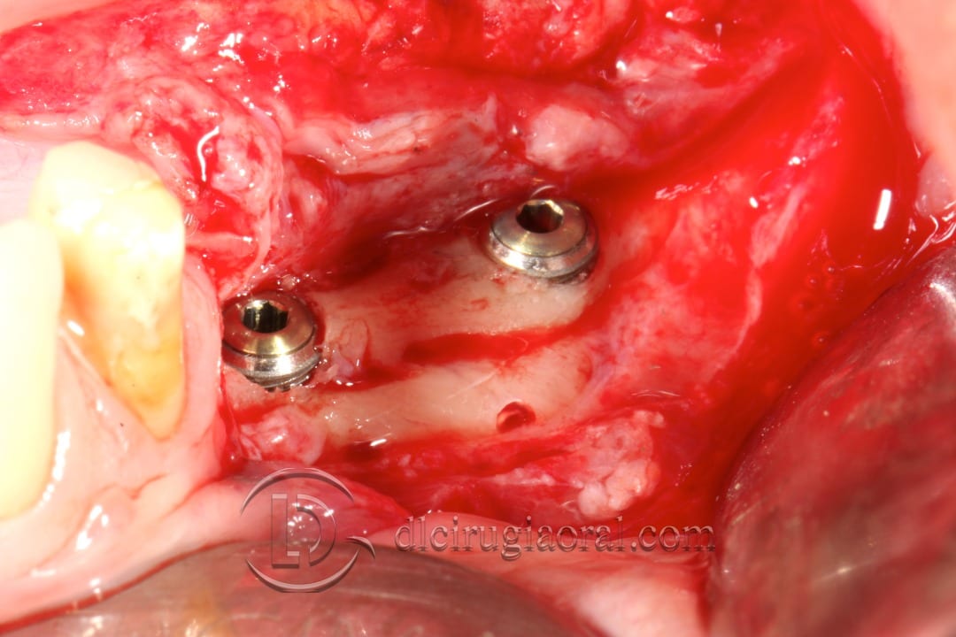 10mm long implants in place
