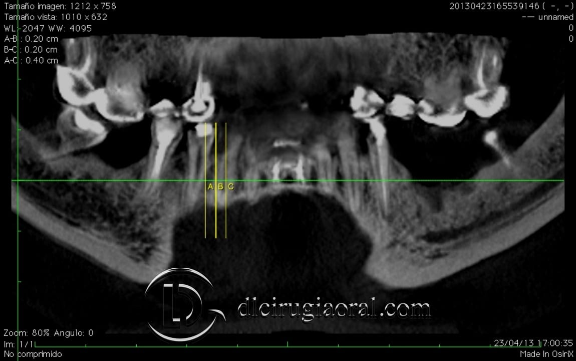 Defect on CT
