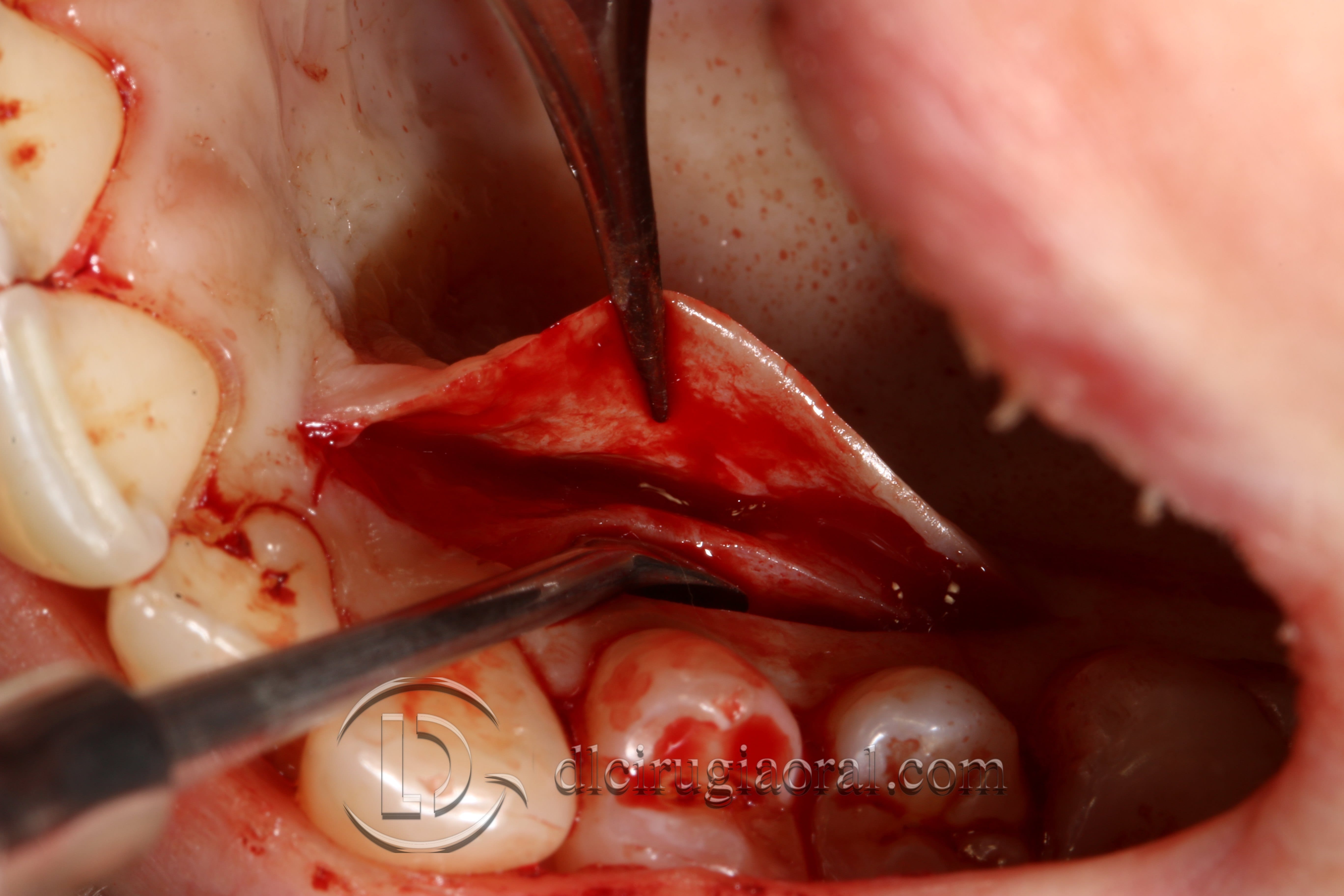 covering recessions after orthodontics