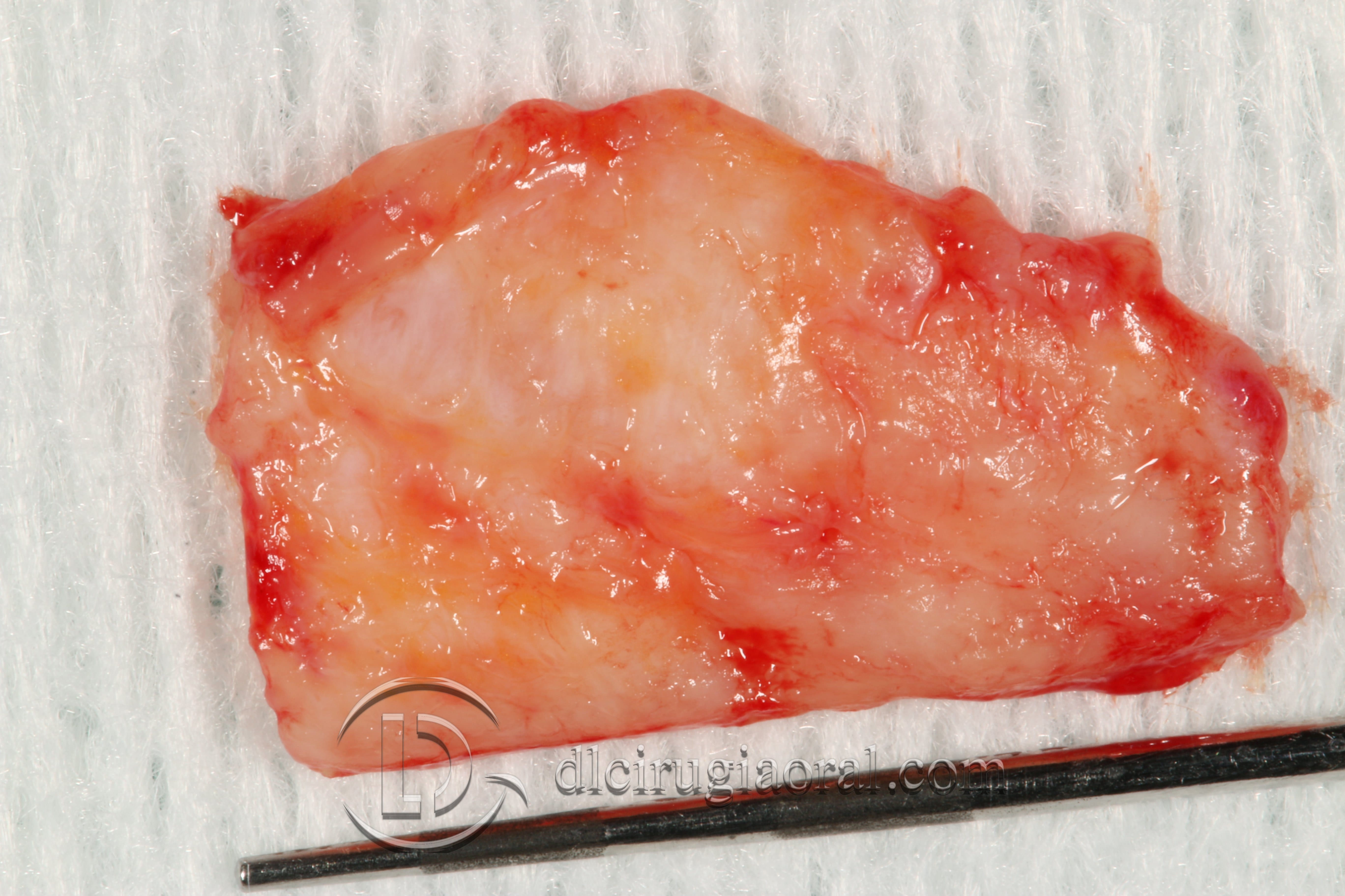 covering recessions after orthodontics