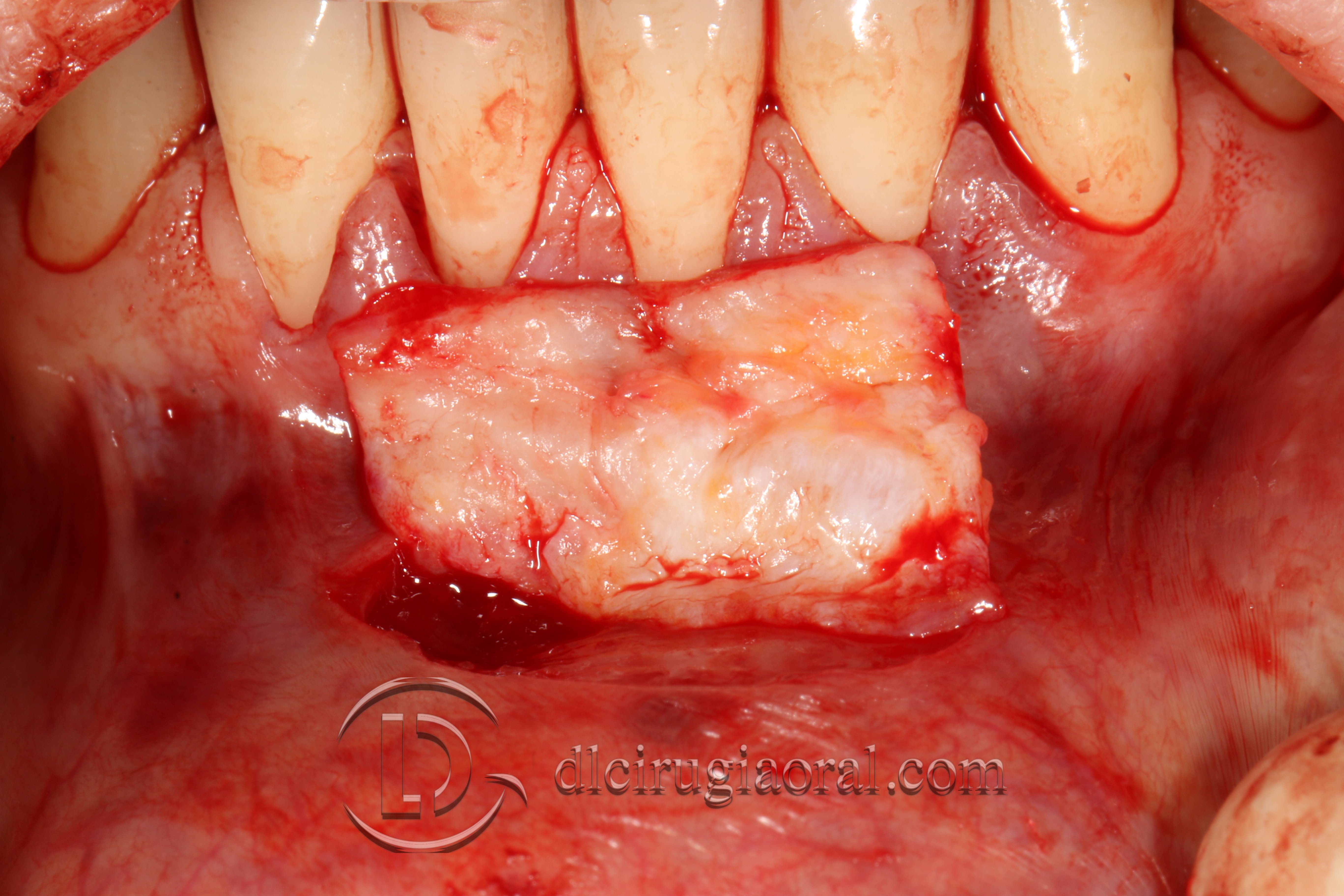 covering recessions after orthodontics