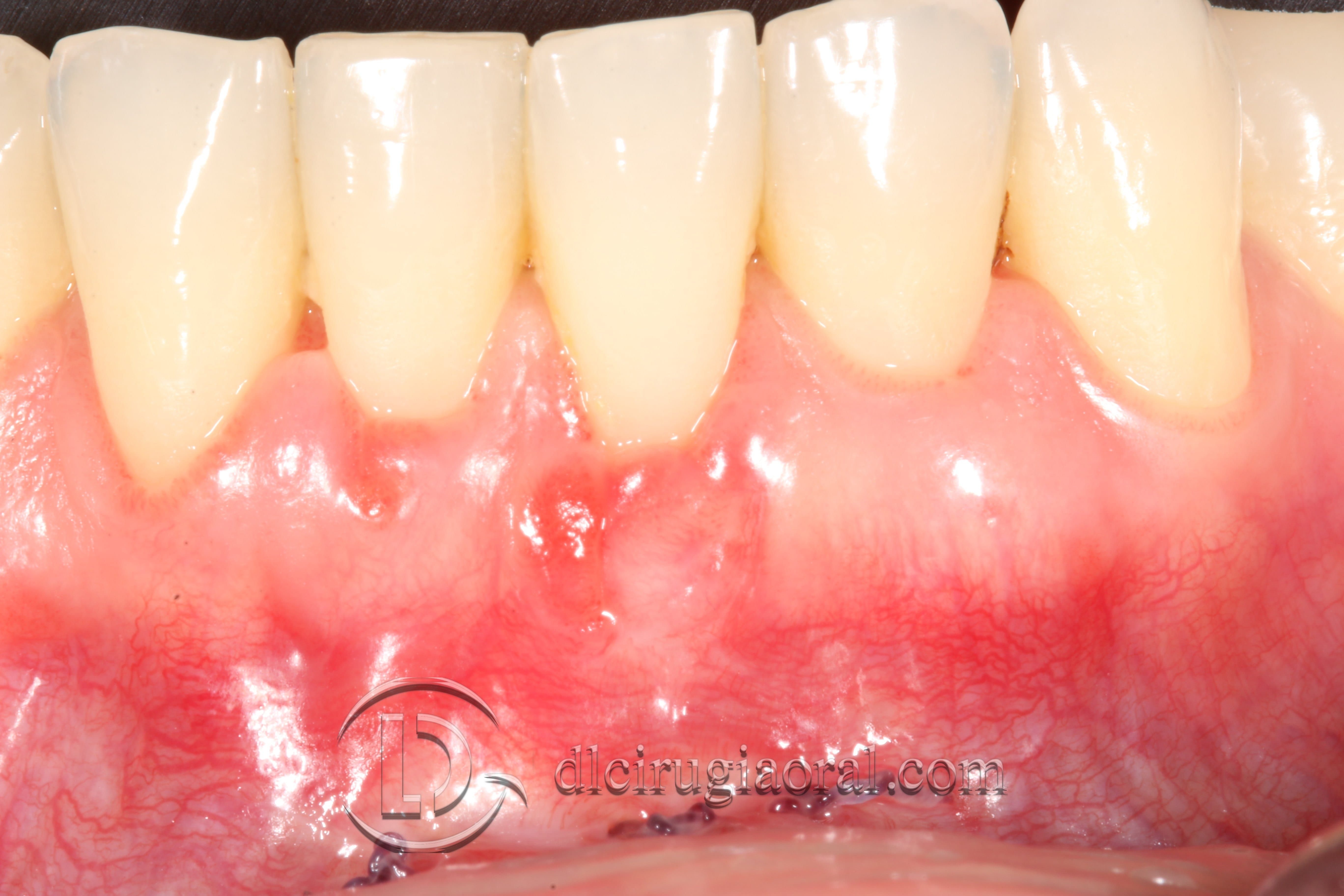 covering recessions after orthodontics