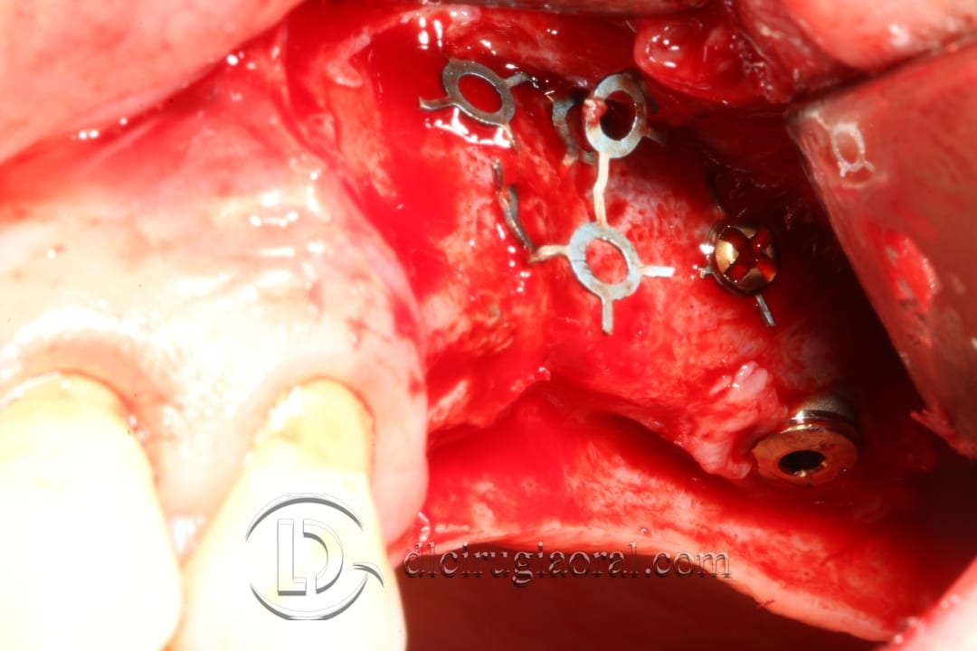 regeneration and sinus lift surgery