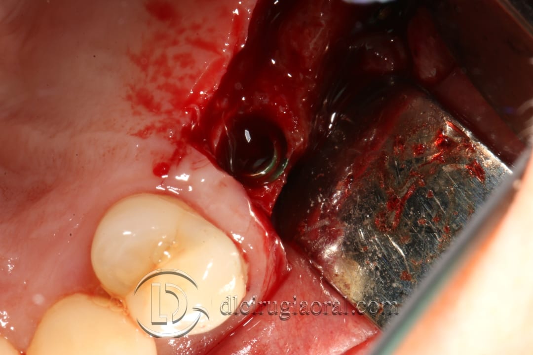 regeneration and sinus lift surgery