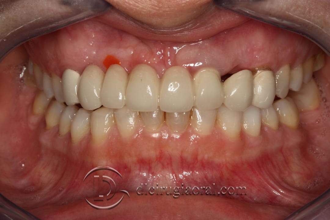 bone reconstruction anterior maxillary section