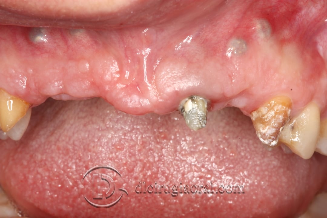bone reconstruction anterior maxillary section