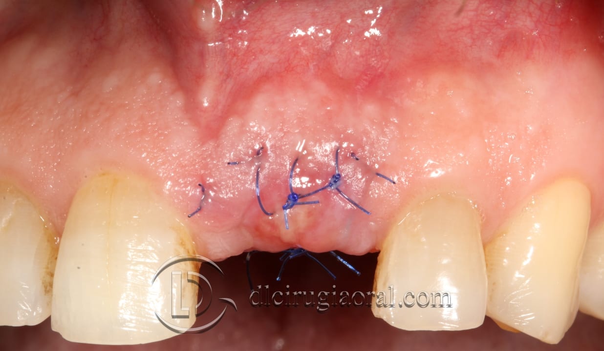 Socket preservation in the aesthetic zone – Clinical case