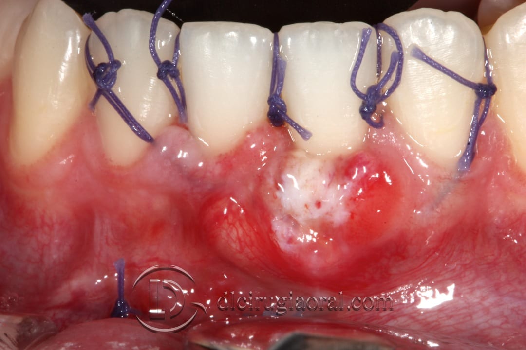 frenectomy and connective tissue graft