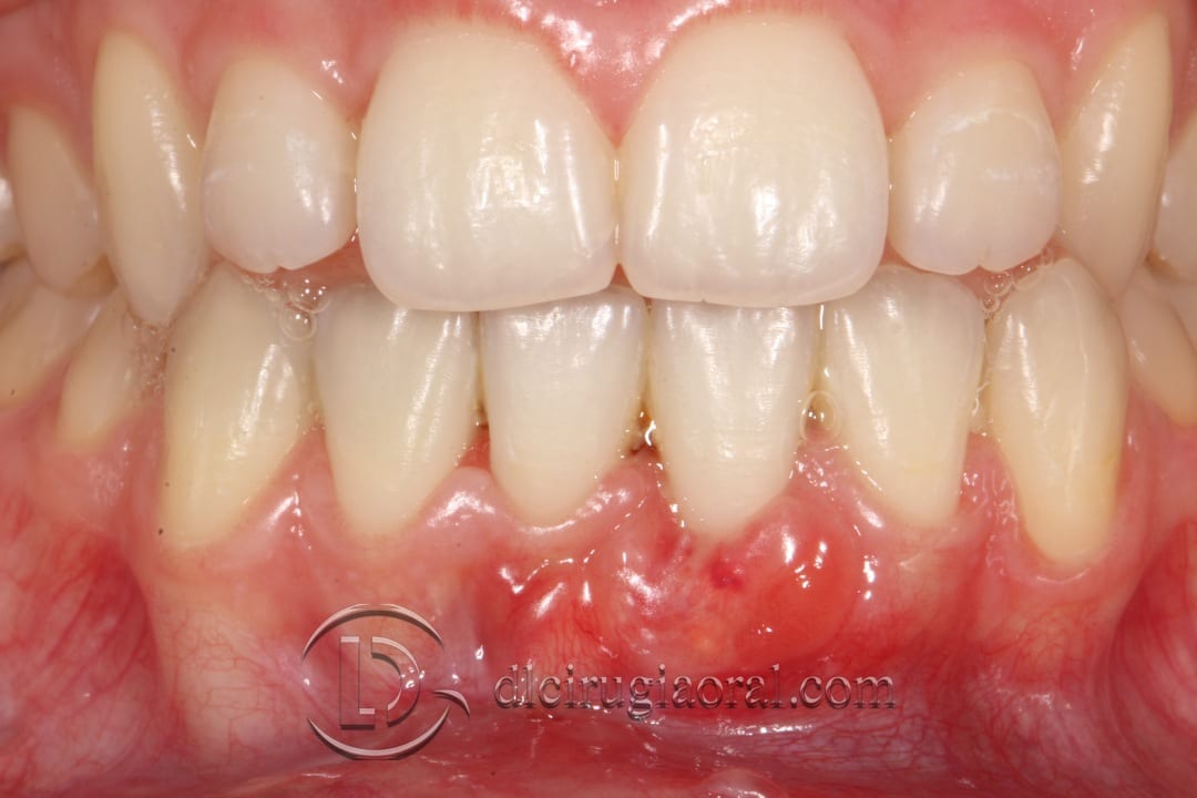 frenectomy and connective tissue graft