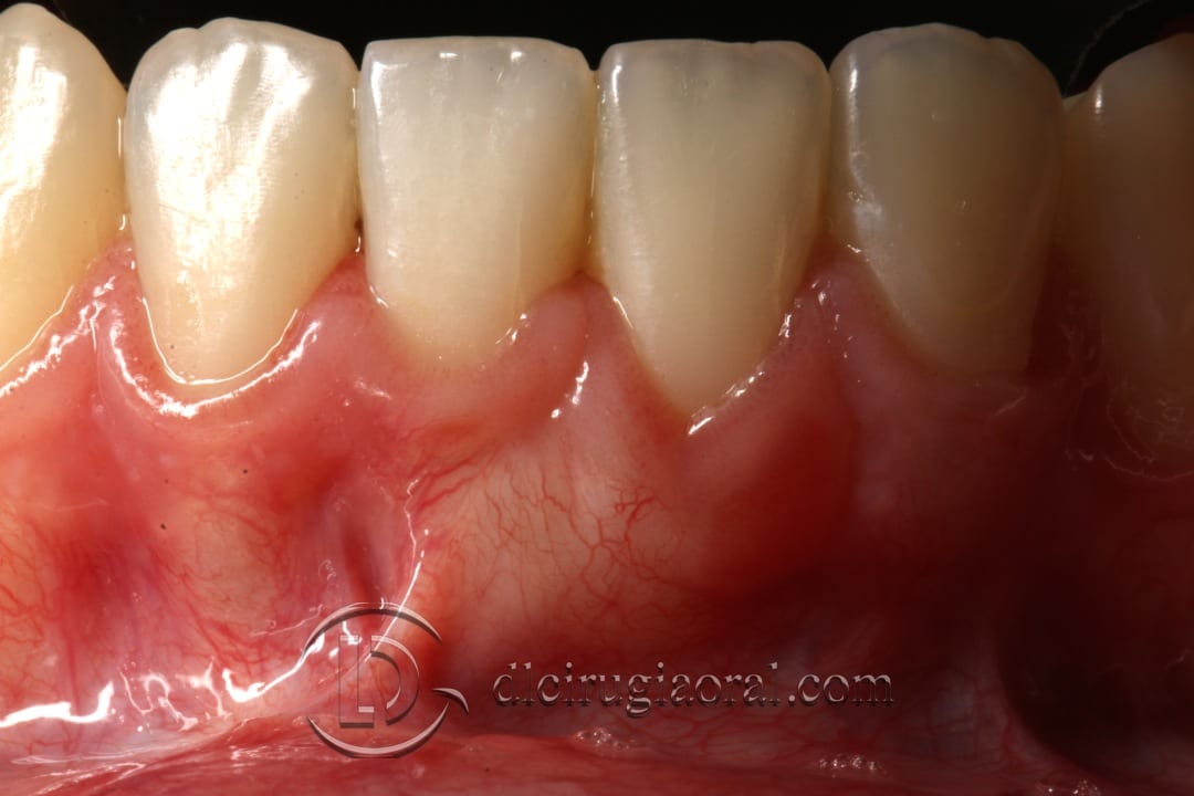 frenectomy and connective tissue graft