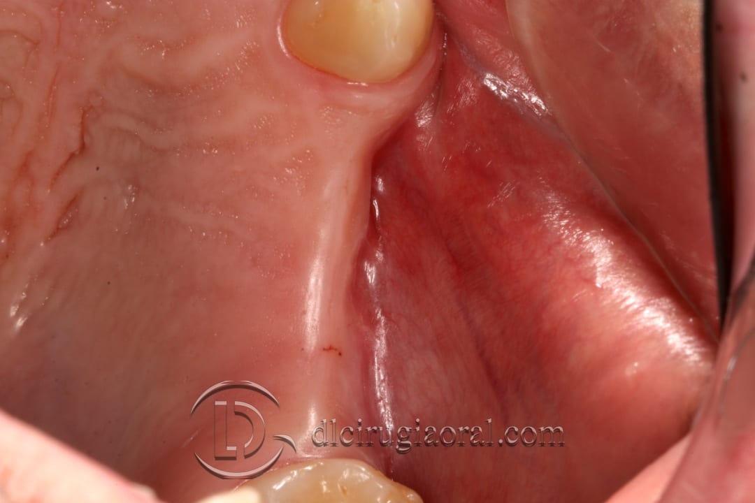 horizontal maxillary gain and implant placement