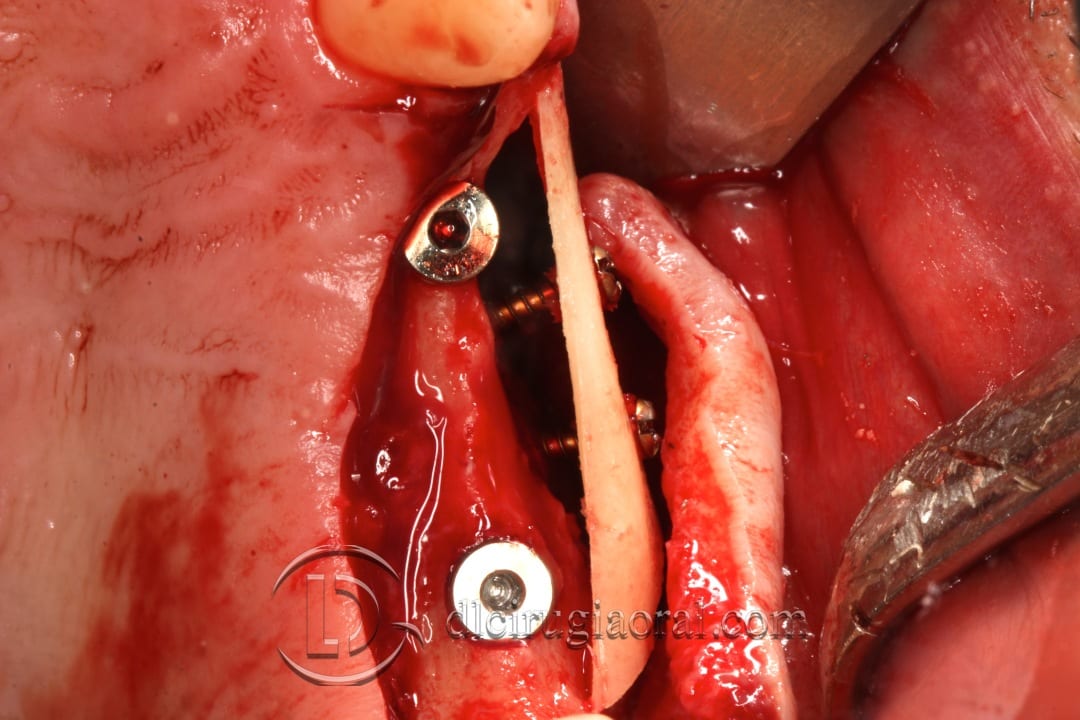 horizontal maxillary gain and implant placement