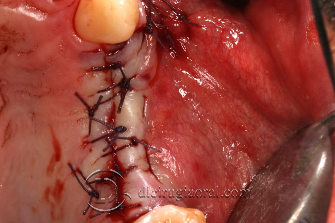 horizontal maxillary gain and implant placement