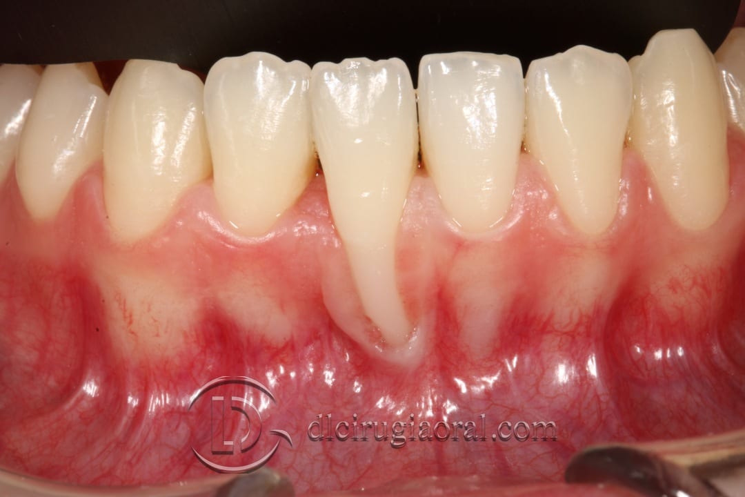 Coverage of a large recession – Connective tissue and frenectomy