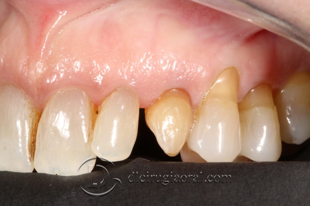 impacted canine extraction and implant