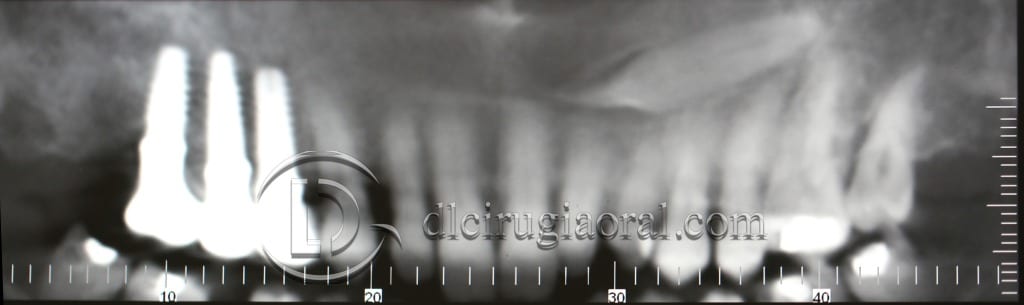 impacted canine extraction and implant