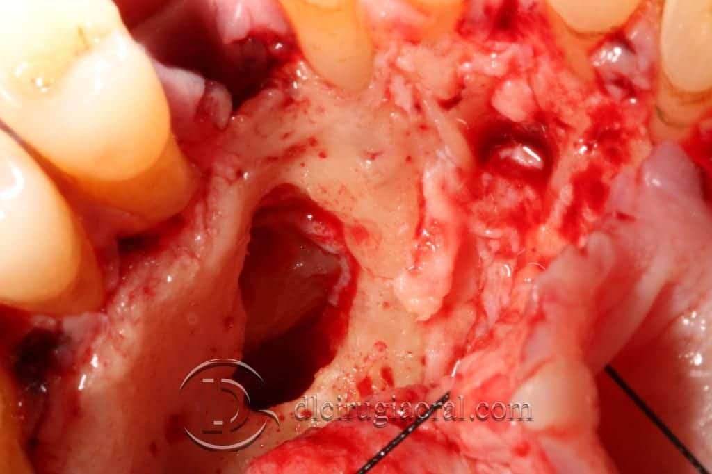 impacted canine extraction and implant