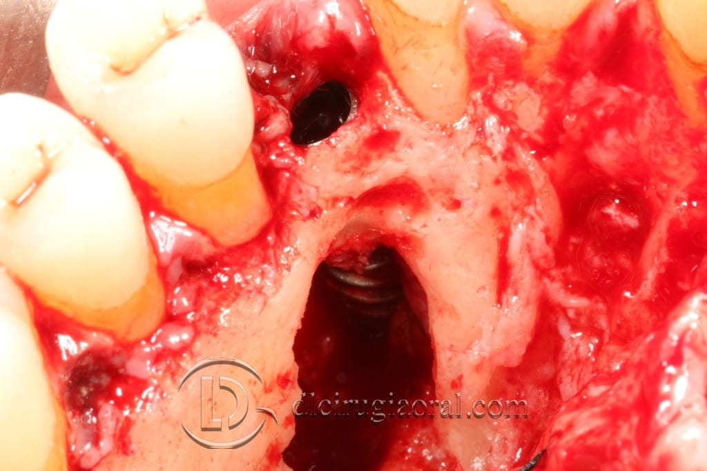 impacted canine extraction and implant