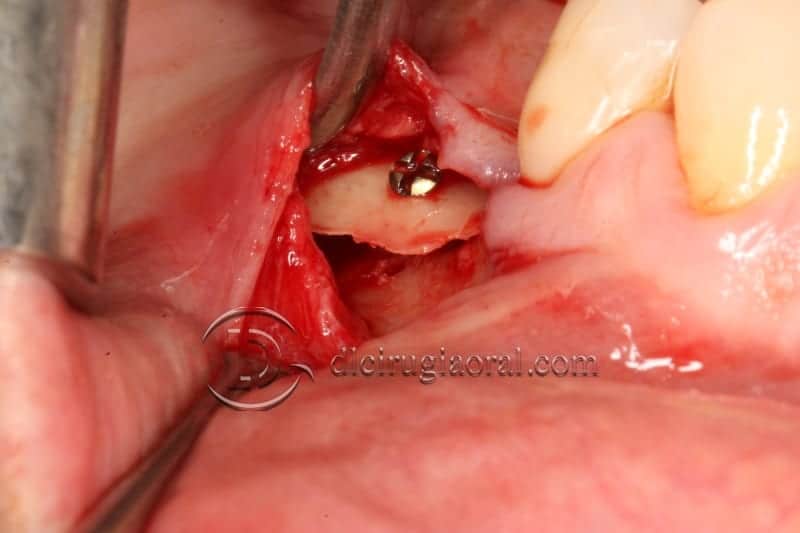 Vertical bone augmentation with the Khoury technique and tunnel approach