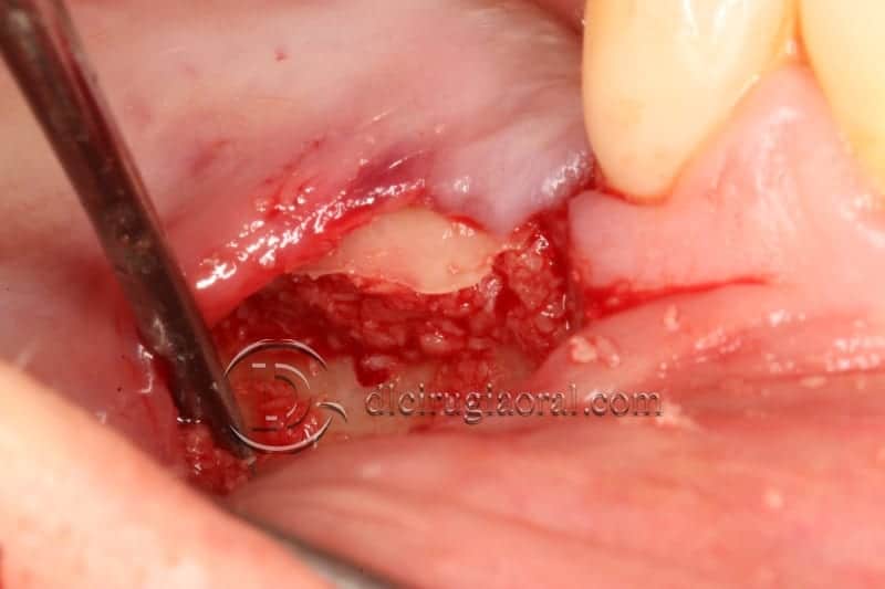 vertical bone augmentation with the Khoury technique