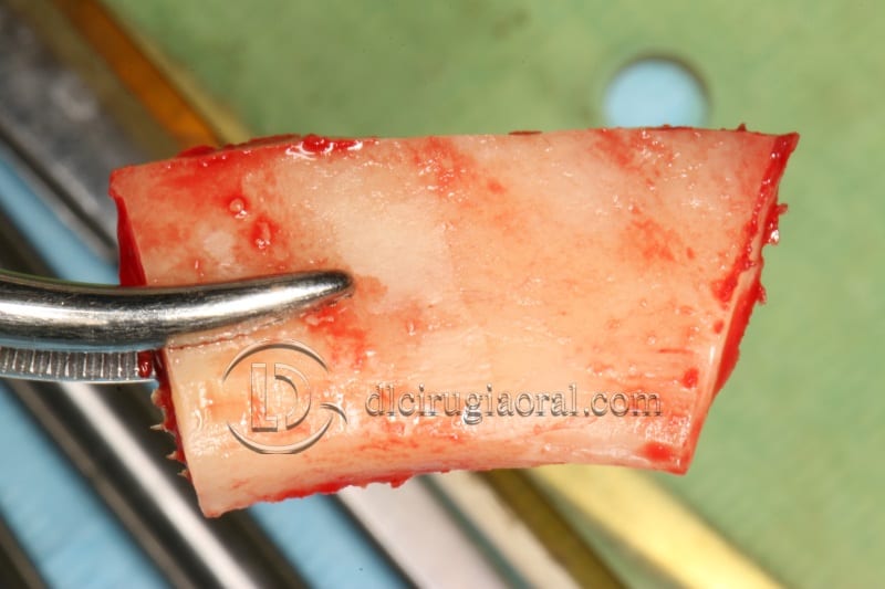 vertical bone augmentation with the Khoury technique