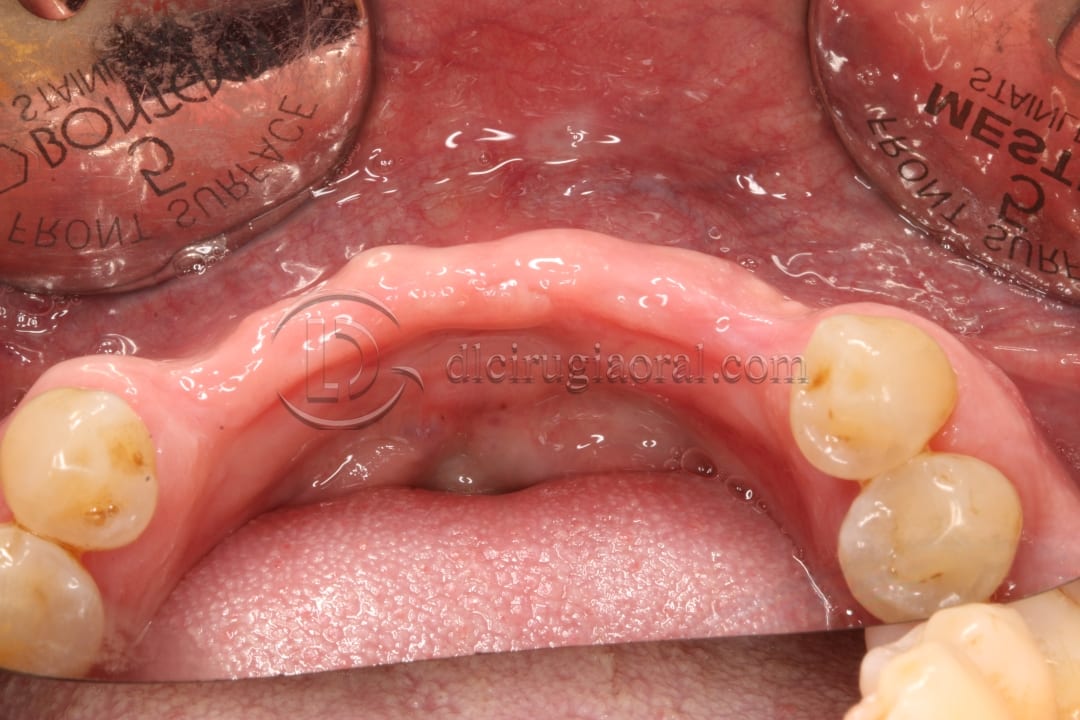 implant placement in augmented area