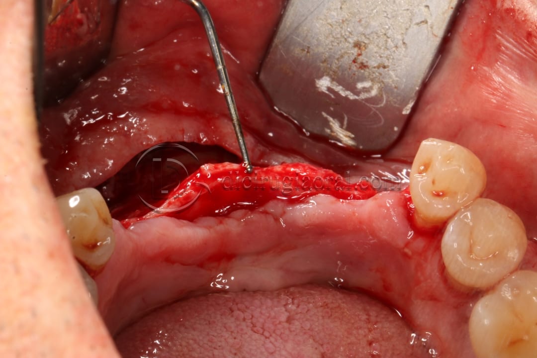Anterior mandible atrophy
