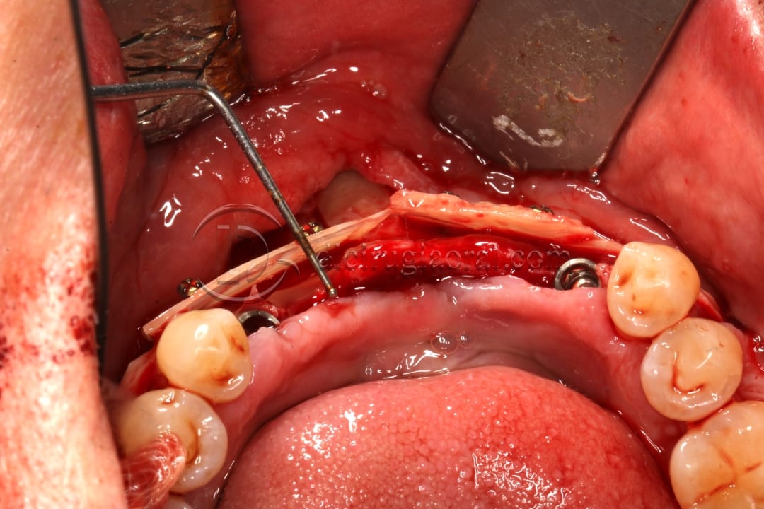 implant placement in augmented area