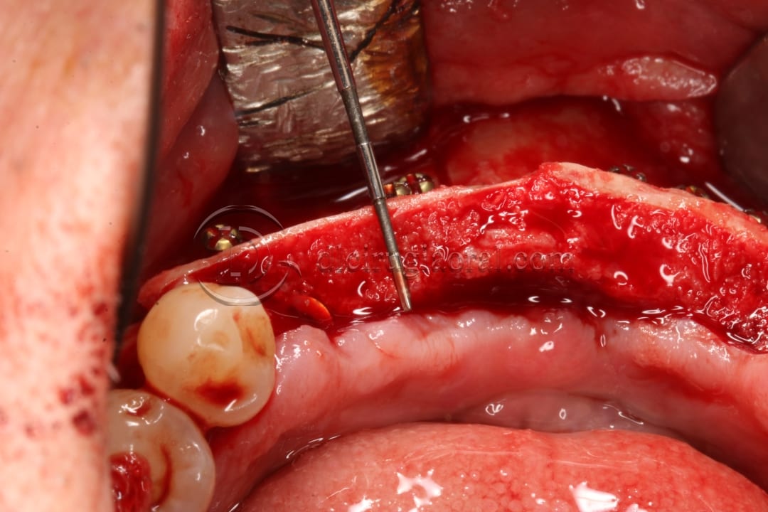 anterior mandible atrophya