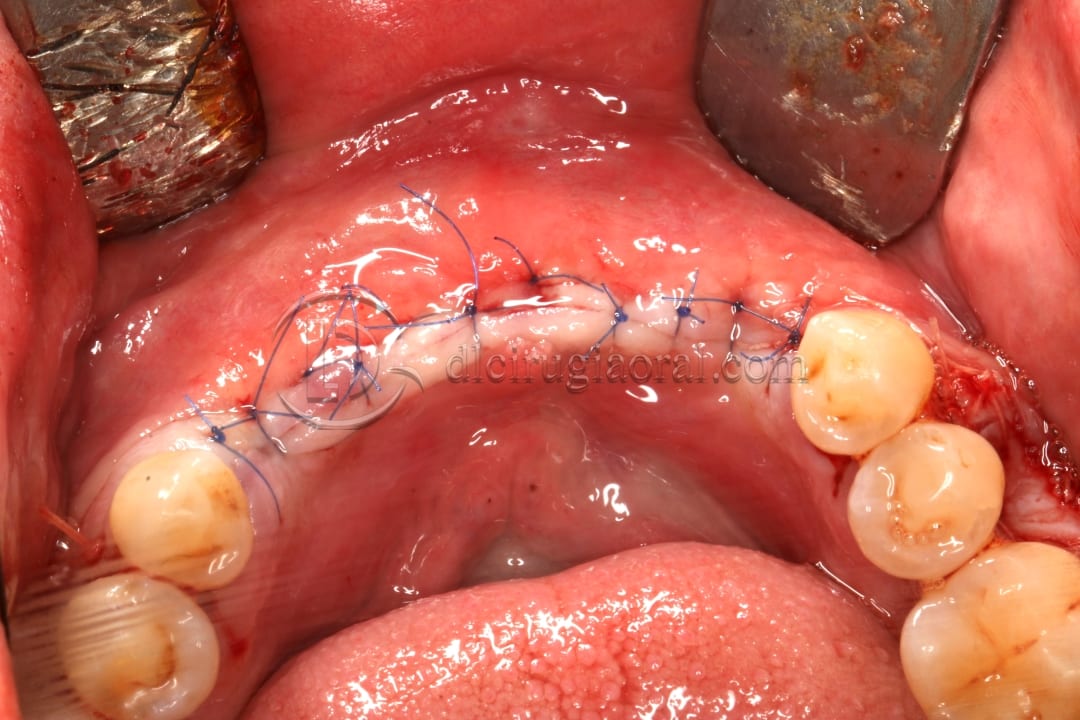 anterior mandible atrophya