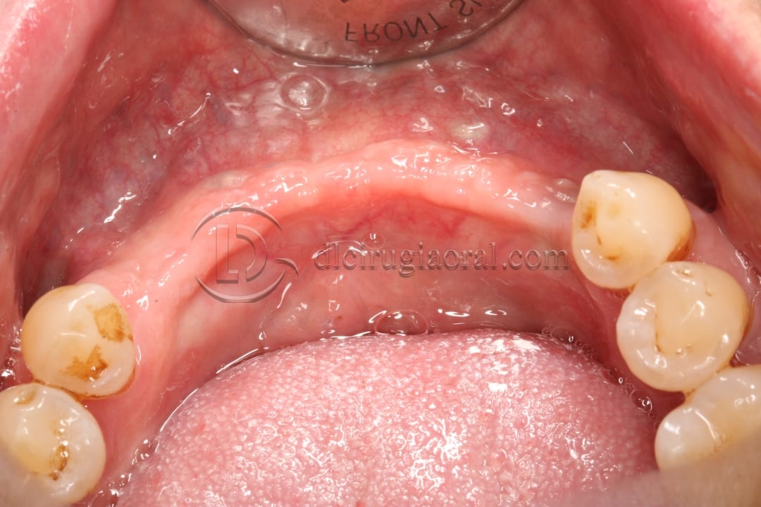 anterior mandible atrophya