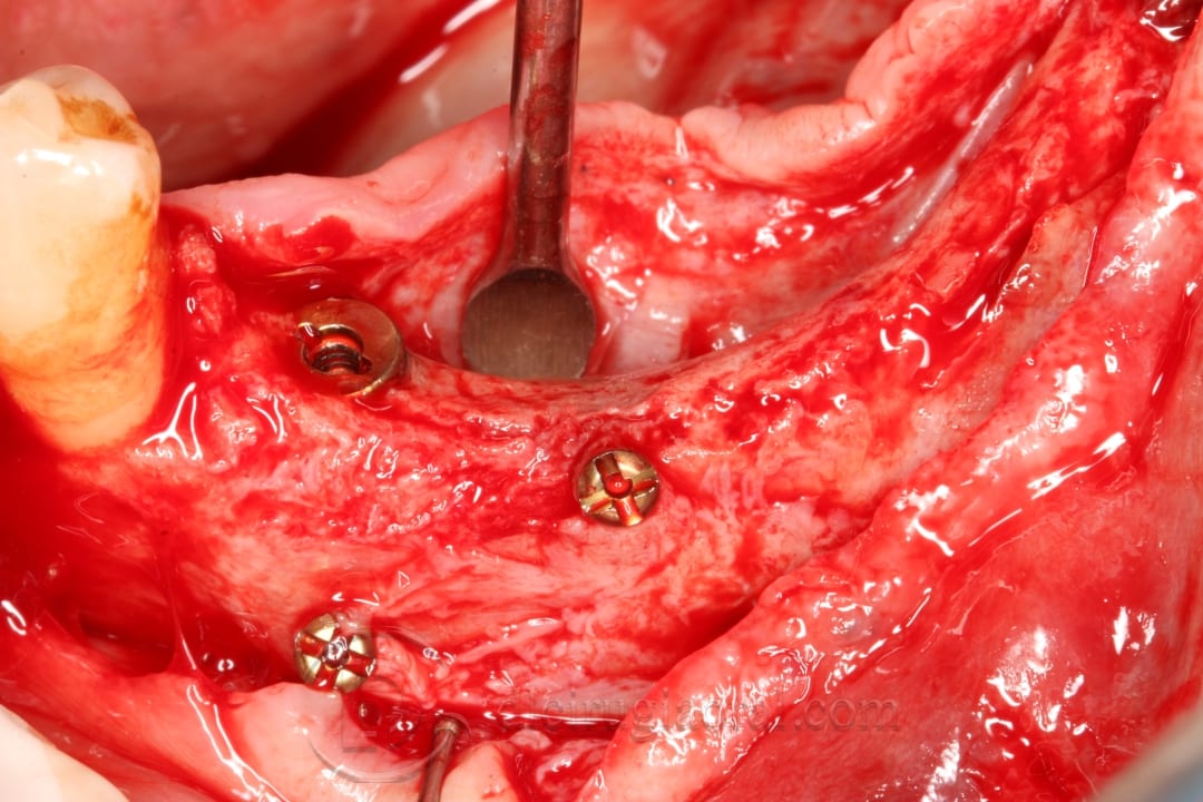 Implant placement in augmented area